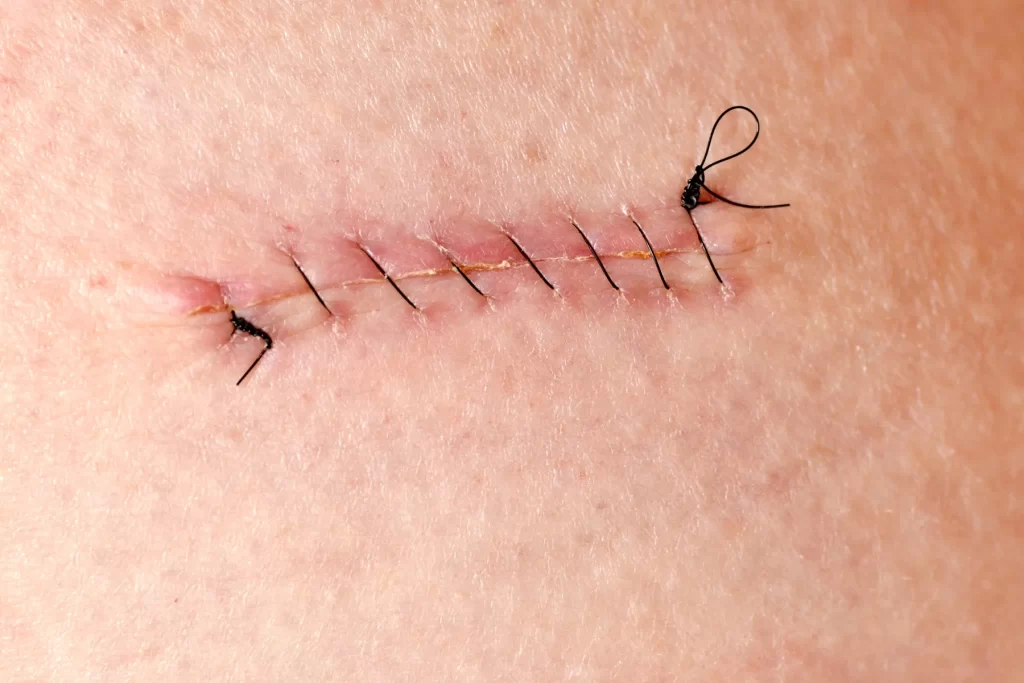 بخیه در منزل