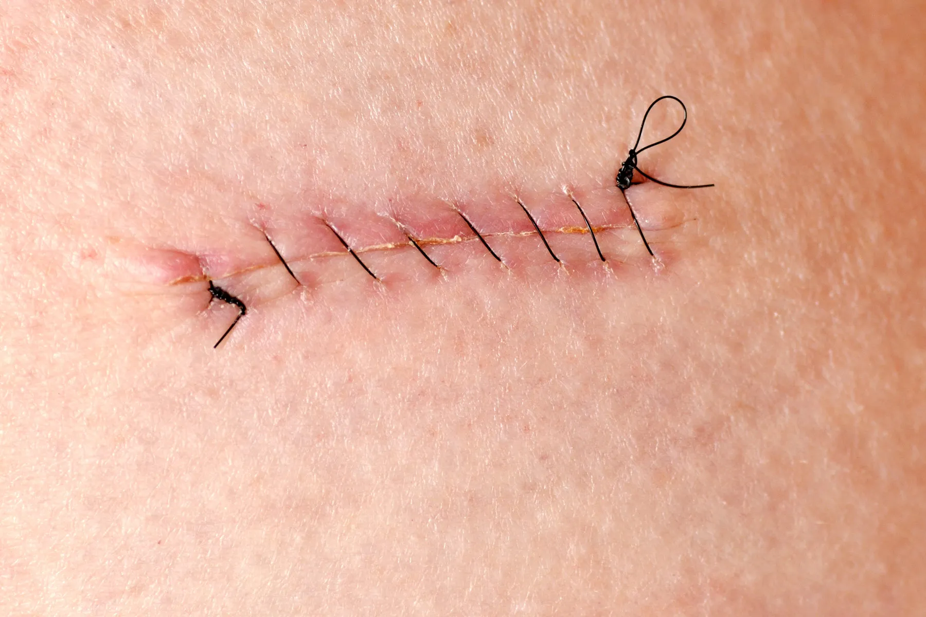 بخیه در منزل